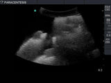 Paracentesis Ultrasound Training Model | Optional Femoral Nerves & Vessels BPPARA-FEM1301-FN-FV | Sim & Skills