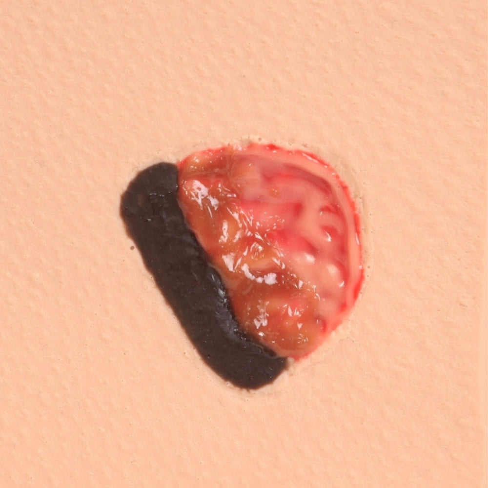 PAT Pressure Injury Staging Model VTA0980 | Sim & Skills