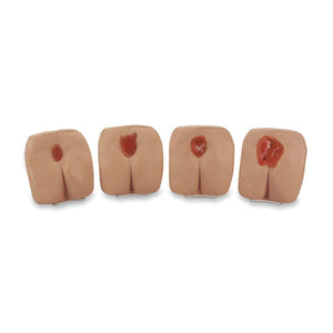 Pressure Ulcer/Bedsore Model Set