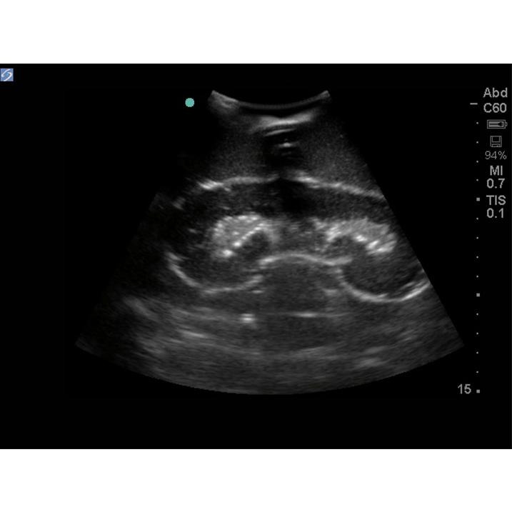 Renal Biopsy Ultrasound Training Model BPRB-2011 | Sim & Skills