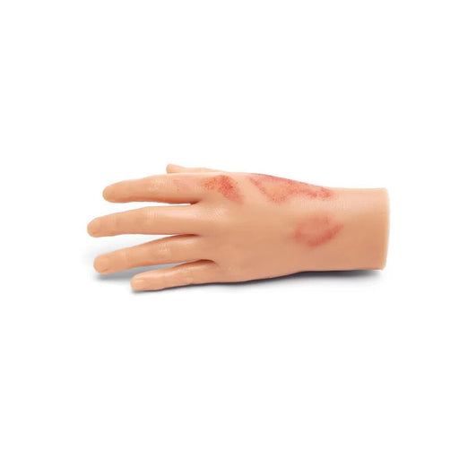 Small Adult Burned Hand M-FMB-001-B | Sim & Skills