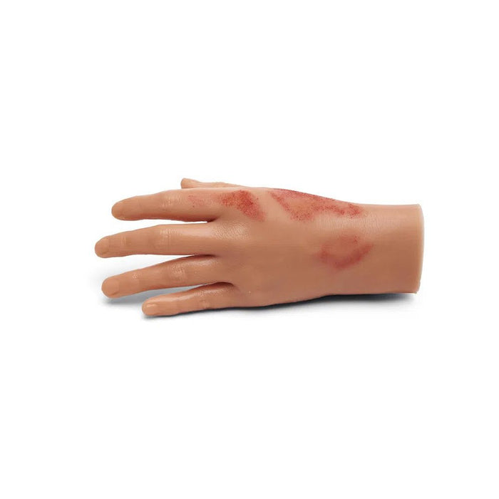 Small Adult Burned Hand M-FMB-001-B | Sim & Skills