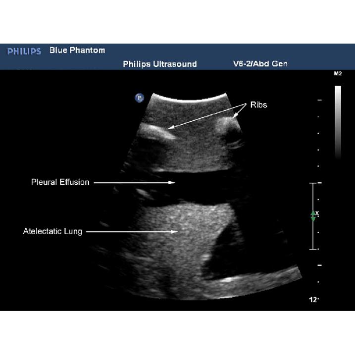 Thoracentesis and Thoracostomy Ultrasound Model BPTT1000-1 | Sim & Skills