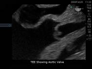 Transoesophageal Echo and Transthoracic Echo Ultrasound Training Model | BP-TEE1702 | Blue Phantom | Sim & Skills