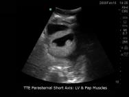 Transthoracic Echocardiography and Pericardiocentesis Ultrasound Training Model | BP-TTE1701-H | Blue Phantom | Sim & Skills