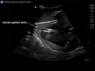 Transthoracic Echocardiography and Pericardiocentesis Ultrasound Training Model | BP-TTE1701-H | Blue Phantom | Sim & Skills