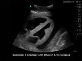 Transthoracic Echocardiography and Pericardiocentesis Ultrasound Training Model | BP-TTE1701-H | Blue Phantom | Sim & Skills