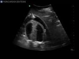 Transthoracic Echocardiography and Pericardiocentesis Ultrasound Training Model | BP-TTE1701-H | Blue Phantom | Sim & Skills