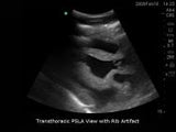 Transthoracic Echocardiography and Pericardiocentesis Ultrasound Training Model | BP-TTE1701-H | Blue Phantom | Sim & Skills