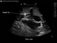 Transthoracic Echocardiography and Pericardiocentesis Ultrasound Training Model | BP-TTE1701-H | Blue Phantom | Sim & Skills